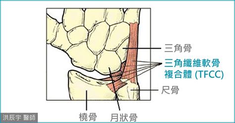 手受傷|手腕的黑盒子 ── 三角纖維軟骨複合體（TFCC）損傷